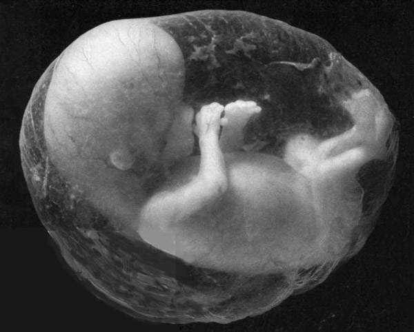Aborto - Causas y complicaciones