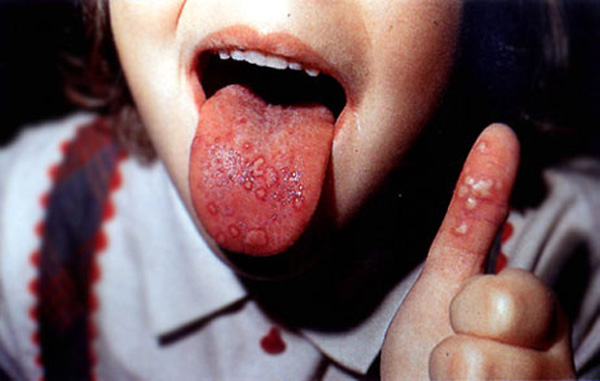 Síndrome mano-pie-boca