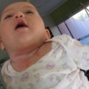 Dermatitis seborreica en el bebe