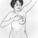 Mastectomía preventiva