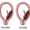 Placenta accreta, increta y percreta