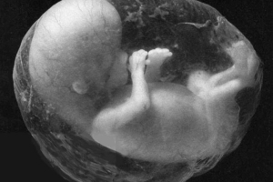 Aborto - Causas y complicaciones