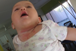 Dermatitis seborreica en el bebe
