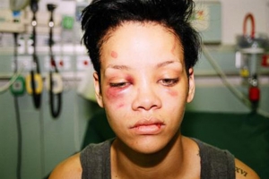 Rihanna tras la gopliza dada por Chris Brown