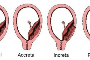 Placenta accreta, increta y percreta